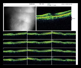 RADIAL LINE OD